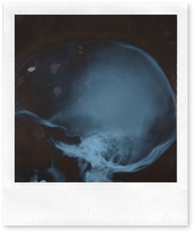 Kahrmann Head Xray 2