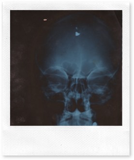 Kahrmann Head Xray 3